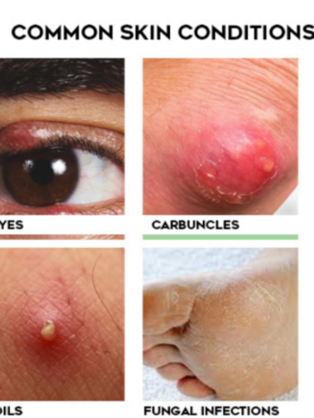 Skin Problems Due to Diabetes